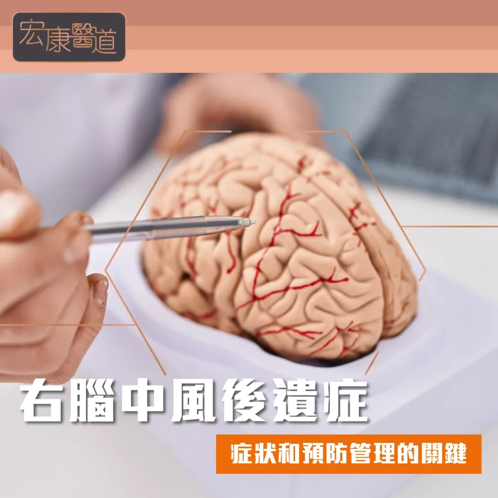 右腦中風後遺症：症狀和預防管理的關鍵