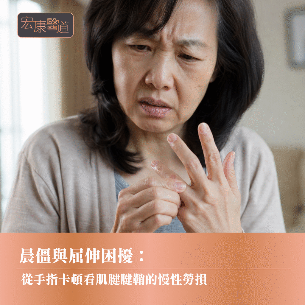 晨僵與屈伸困擾： 從手指卡頓看肌腱腱鞘的慢性勞損