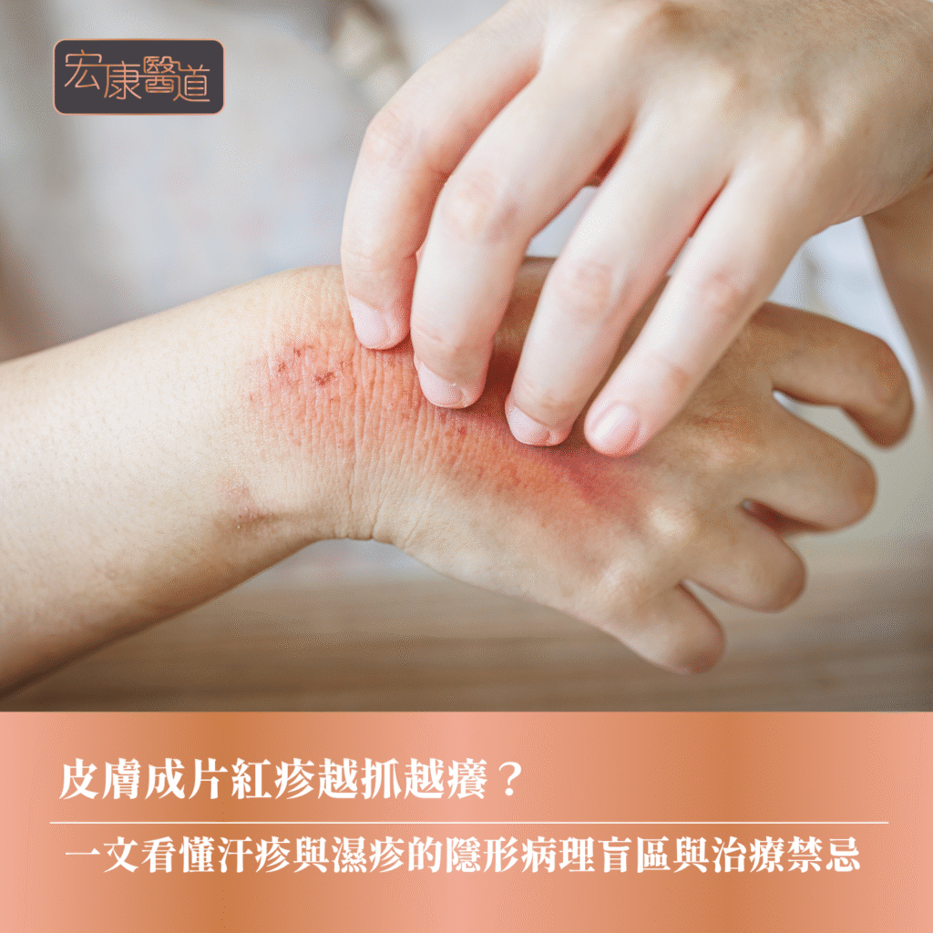 皮膚成片紅疹越抓越癢？ 一文看懂汗疹與濕疹的隱形病理盲區與治療禁忌