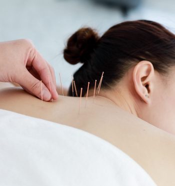 hand of doctor performing acupuncture therapy . Asian female undergoing acupuncture treatment with a line of fine needles inserted into the her body skin in clinic hospital